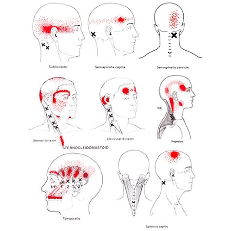 Each <b>trigger</b> <b>point</b> is a hard, sore spot within a skeletal muscle. . Occipital neuralgia massage trigger points